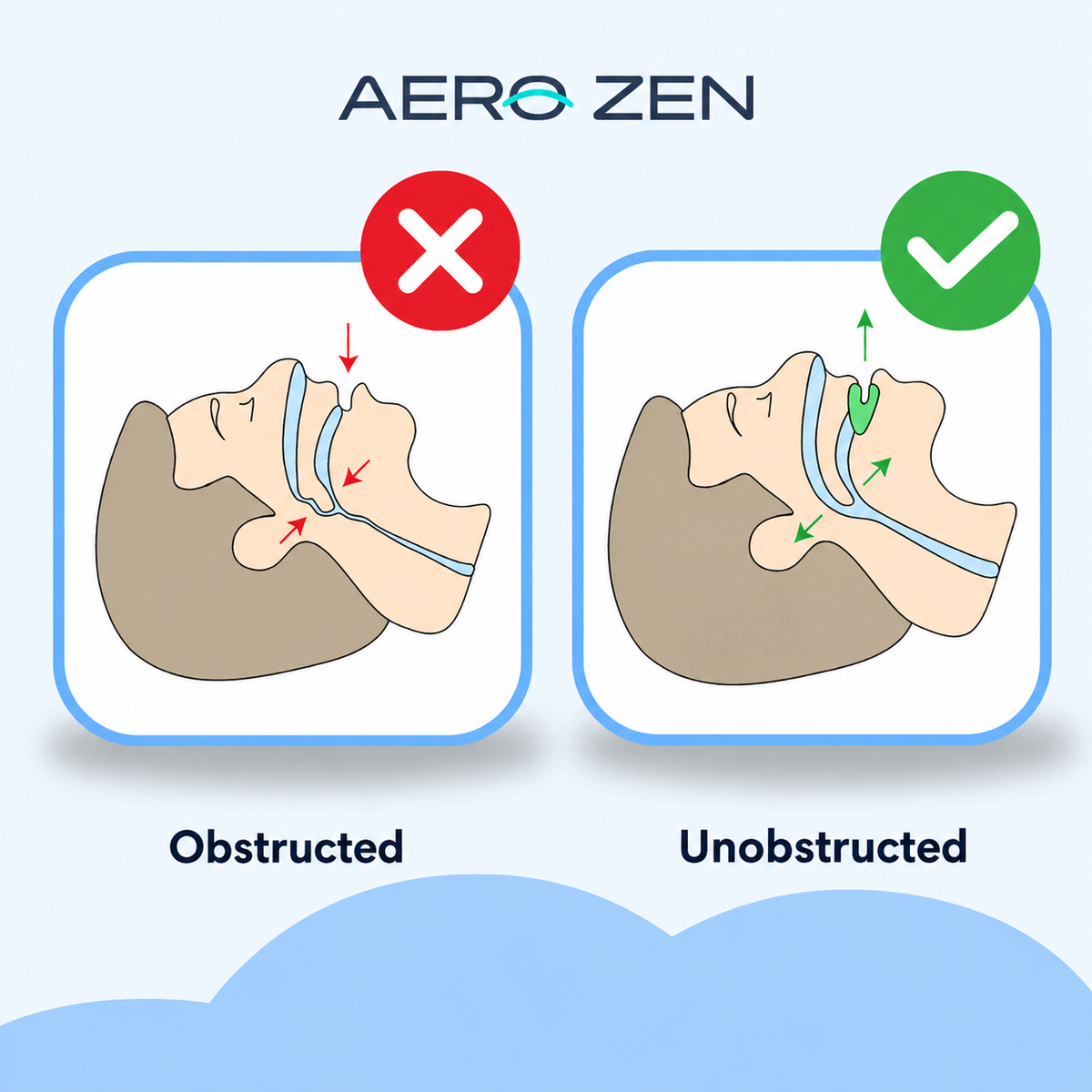 AeroSleep PRO – Anti-Snoring Mouthpiece